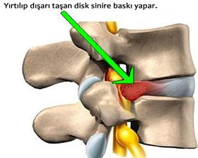 Bel Fıtığı Anatomi