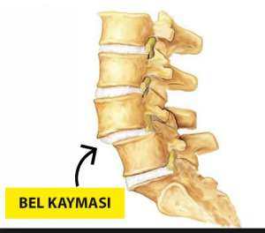 Bel Kayması 3