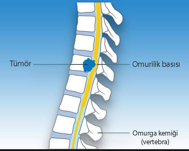 Omurilik Tümörleri Ameliyat Öncesi Görüntü