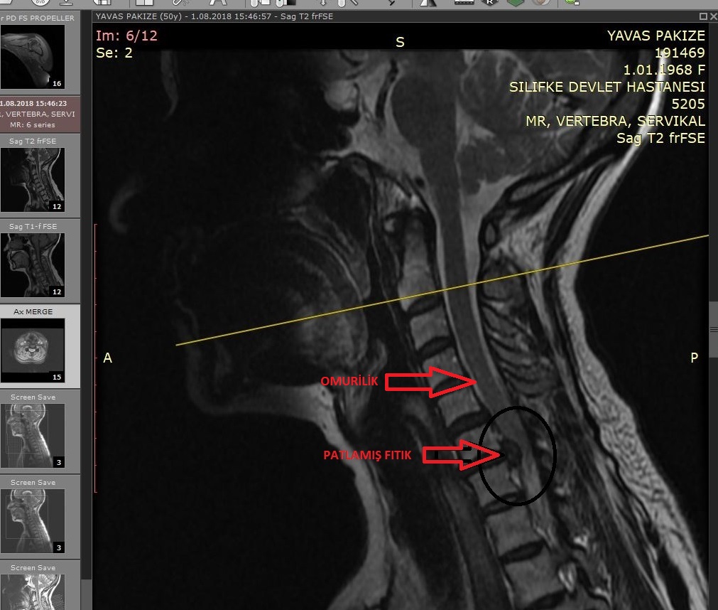 Servikal Disk Anatomisi